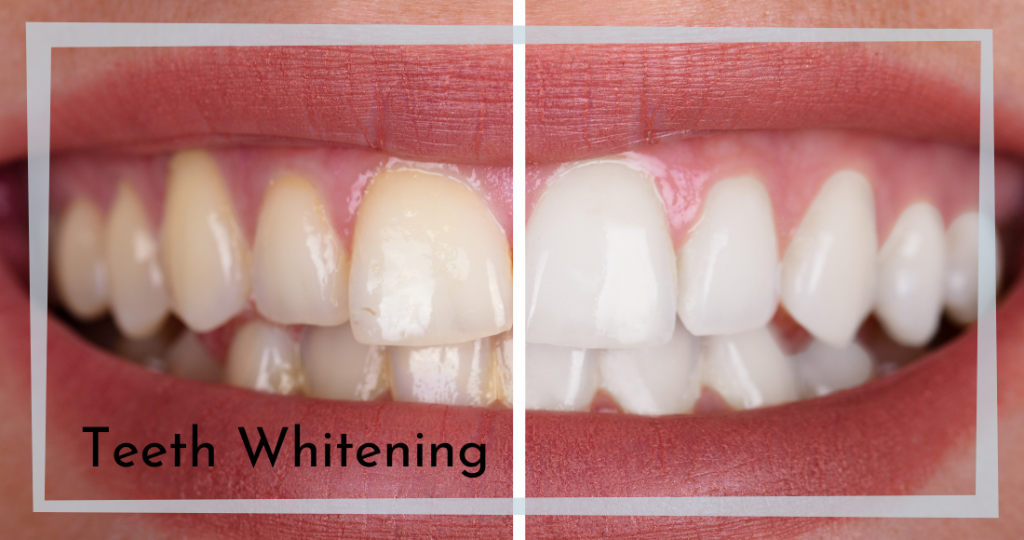 Brighten Your Smile Teeth Whitening at Omaha Family Dental